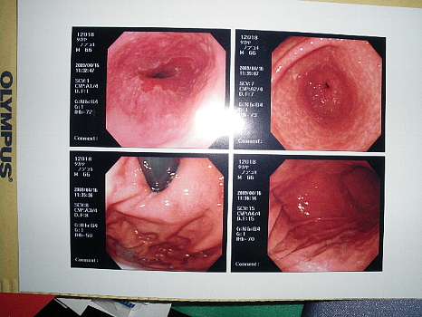 小生の胃と十二指腸